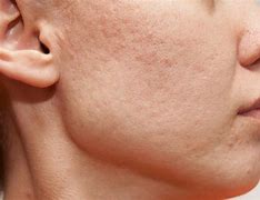 Image result for What Are Face Blemishes