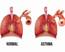 Image result for Lungs with Asthma