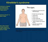 Image result for Kleinfelder's Syndrome