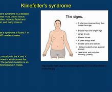 Image result for Klinefelter%27s Syndrome