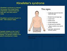 Image result for Klinefelter Disease