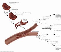 Image result for Sickle Cell Disease