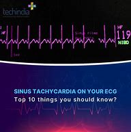 Image result for Sinus Tachycardia
