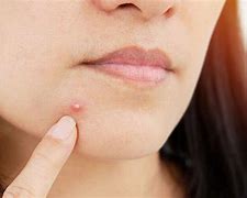 Image result for Different Types of Pimples