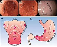 Image result for Stage 1B Stomach Cancer