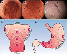 Image result for Stage 1B Stomach Cancer