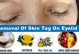Image result for How to Remove a Skin Tag On Eyelid