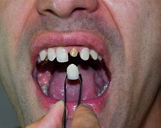 Image result for Teeth Filed Before Veneers