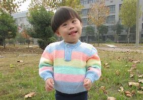 Image result for Asian Down Syndrome