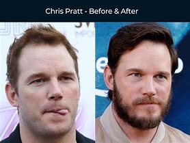 Image result for Chris Pratt and Hair Plug