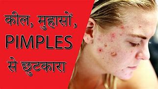 Image result for How to Remove Pimples Overnight