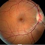 Image result for Retrobulbar Optic Neuritis Oct