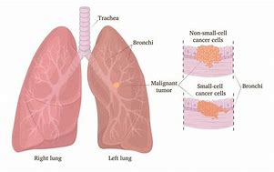 Image result for Stage 4 Lung Cancer Treatment
