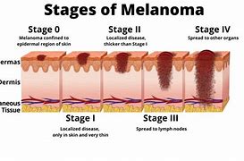 Image result for Clarks Stage 4 Melanoma