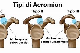 Image result for Acromi