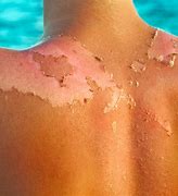 Image result for How to Treat SunBurn