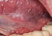 Image result for Stage 4 Tongue Cancer