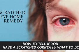 Image result for Eye Scratch Symptoms