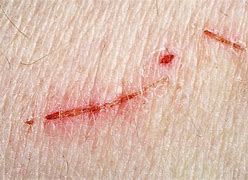 Image result for Scratches On Human Skin