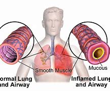 Image result for Persistent Asthma