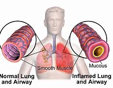 Image result for What Is Asthma