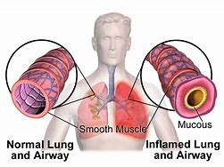 Image result for Asthma Therapy