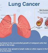 Image result for Lung Cancer Symptoms