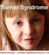 Image result for Meryl Streep Turner's Syndrome