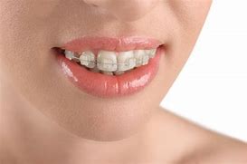 Image result for Ceramic Braces for Adults