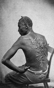 Cicatrices de Gordon un esclave fouett de la Louisiane