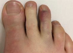 Image result for How to Fix a Broken Toe