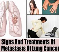 Image result for Metastatic Lung Cancer Symptoms