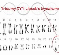 Image result for Jacobs Syndrome