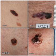 Image result for Melanoma vs Skin Cancer