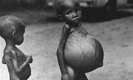Image result for starving children 
