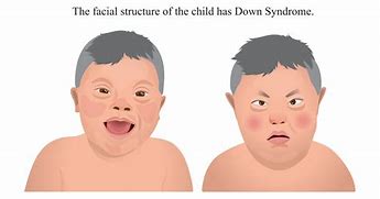 Image result for Person with Down Syndrome Underwater