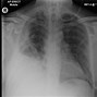 Image result for Flail Chest Patient Positioning