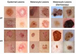 Image result for Stage 0 Skin Cancer