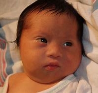 Image result for Down Syndrome Facial Features