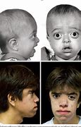 Image result for Pfeiffer Syndrome Life Expectancy