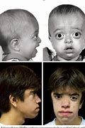 Image result for Causes of Pfeiffer Syndrome
