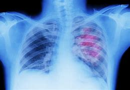 Image result for Stage 4 Cancer X-ray