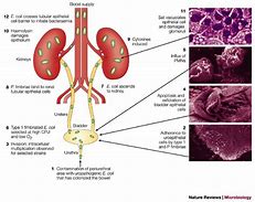 Image result for Urinary Tract Infection
