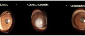 Image result for Corneal Blindness