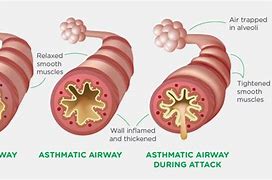Image result for Child Asthma Attack