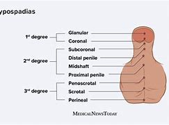 Image result for Hypospadia and Abdominal Mass