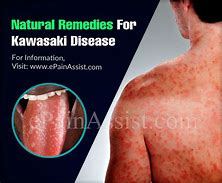 Image result for Kawasaki Disease
