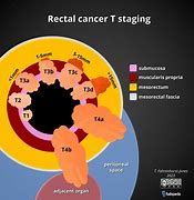 Image result for Rectal Cancer T Stage