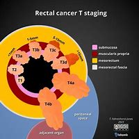 Image result for Liver Stage 4 Colon Cancer