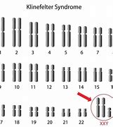 Image result for Klinefelter's Syndrome Chromosomes